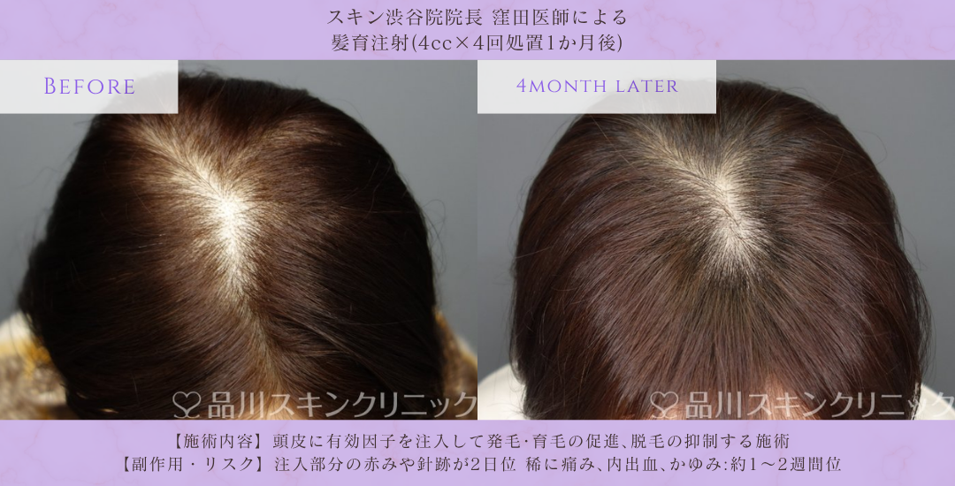 髪育注射 発毛治療 症例 渋谷