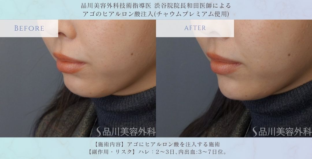 alt="アゴのヒアルロン酸 Eライン改善 症例"