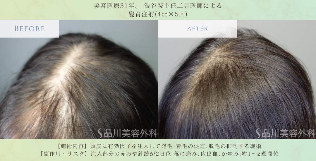 髪育注射 薄毛治療 ビフォーアフター