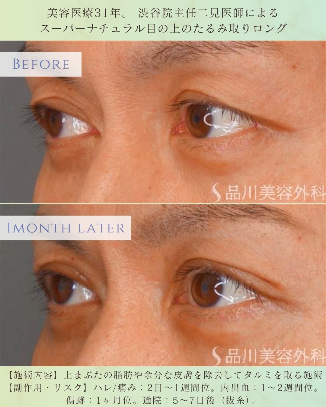 目の上のたるみ取り 症例 モニター