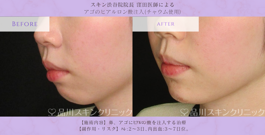 アゴ形成 ビフォーアフター