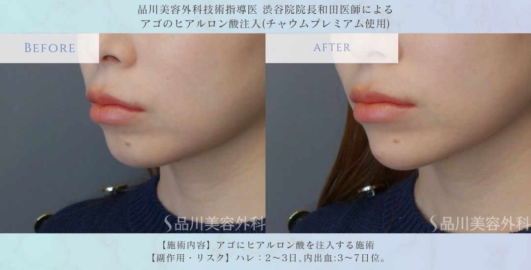alt="フェイスライン改善 アゴヒアルロン酸 症例"