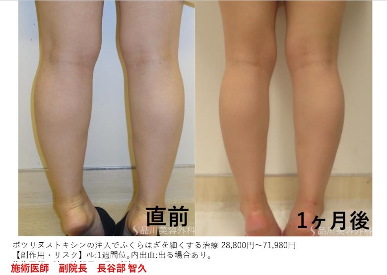 渋谷院 長谷部 智久医師によるふくらはぎのボツリヌス注射 39 580 品川美容外科症例モニター募集 全国版