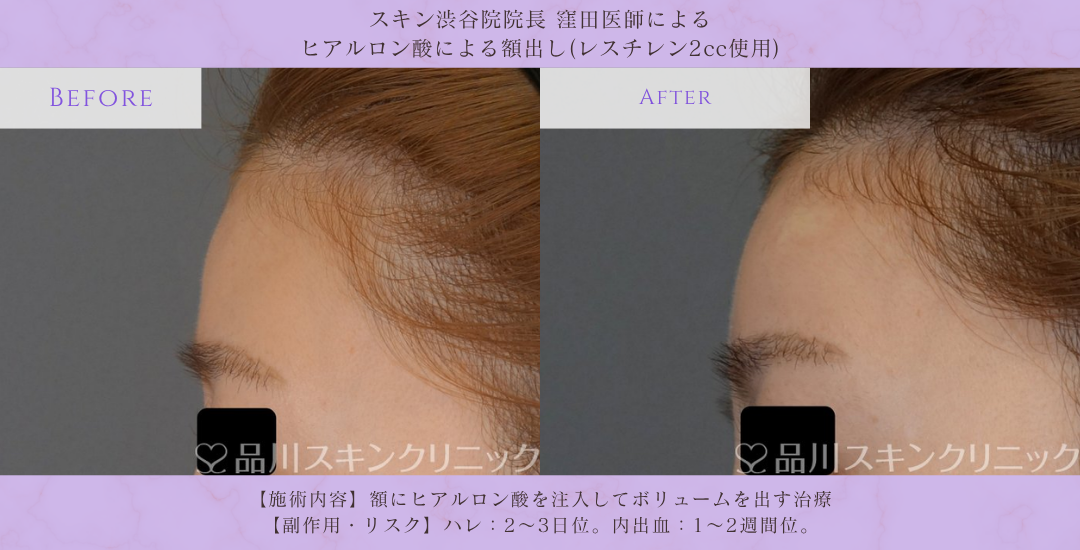 額形成 ヒアルロン酸 症例