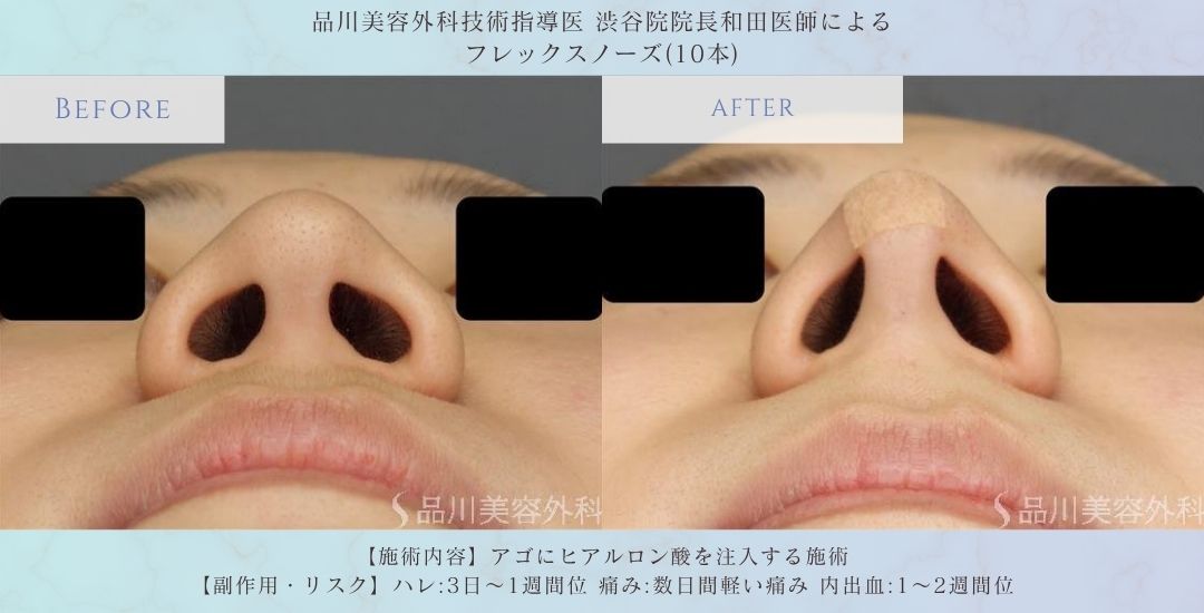alt="フレックスノーズ ビフォーアフター 症例"
