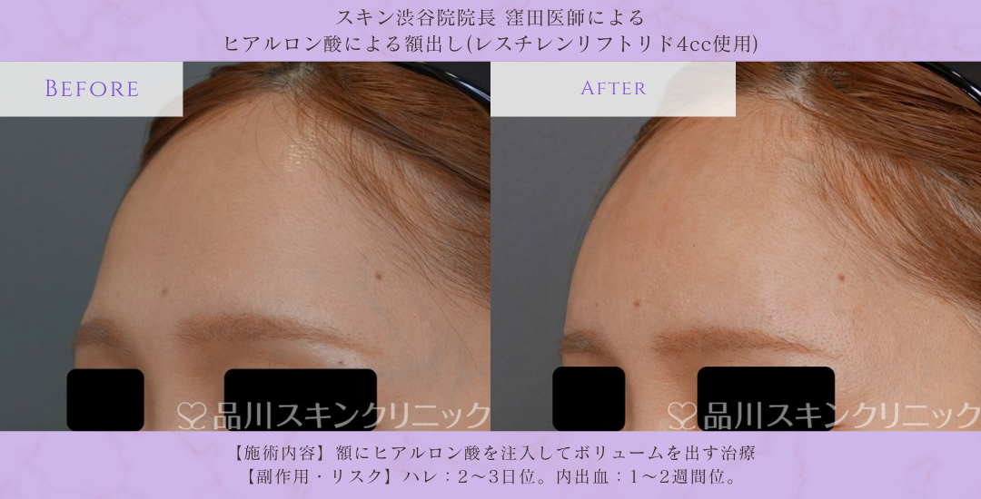 額ヒアルロン酸 女性 症例写真