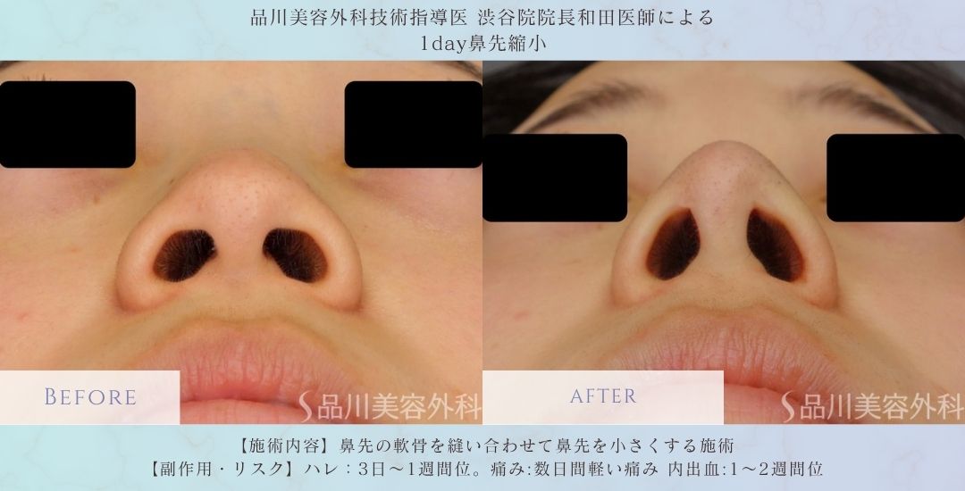 alt="1day鼻先縮小 術前術後 比較 症例"