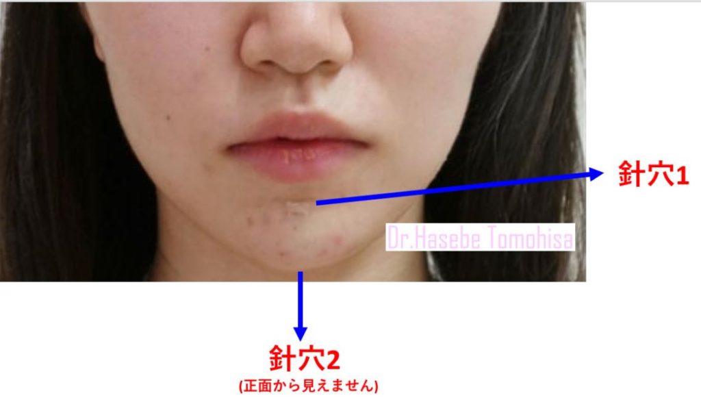 渋谷院 長谷部 智久医師による1day Eライン 137 500 品川美容外科症例モニター募集 全国版 渋谷院 長谷部 智久医師による1day Eライン 137 500 品川美容外科症例モニター募集 全国版