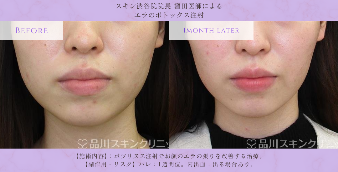 エラボトックス モニター 症例写真