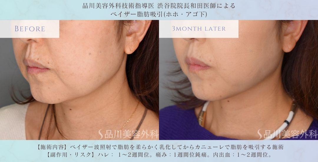 アゴ下 脂肪吸引 二重あご改善 症例