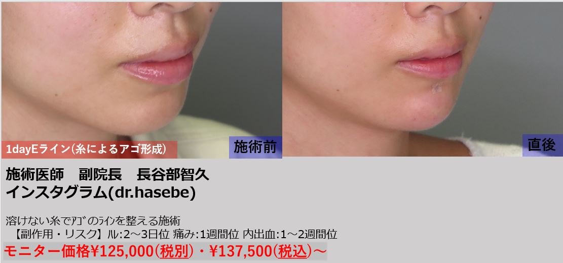 渋谷院 長谷部 智久医師による1day Eライン 137 500 品川美容外科症例モニター募集 全国版