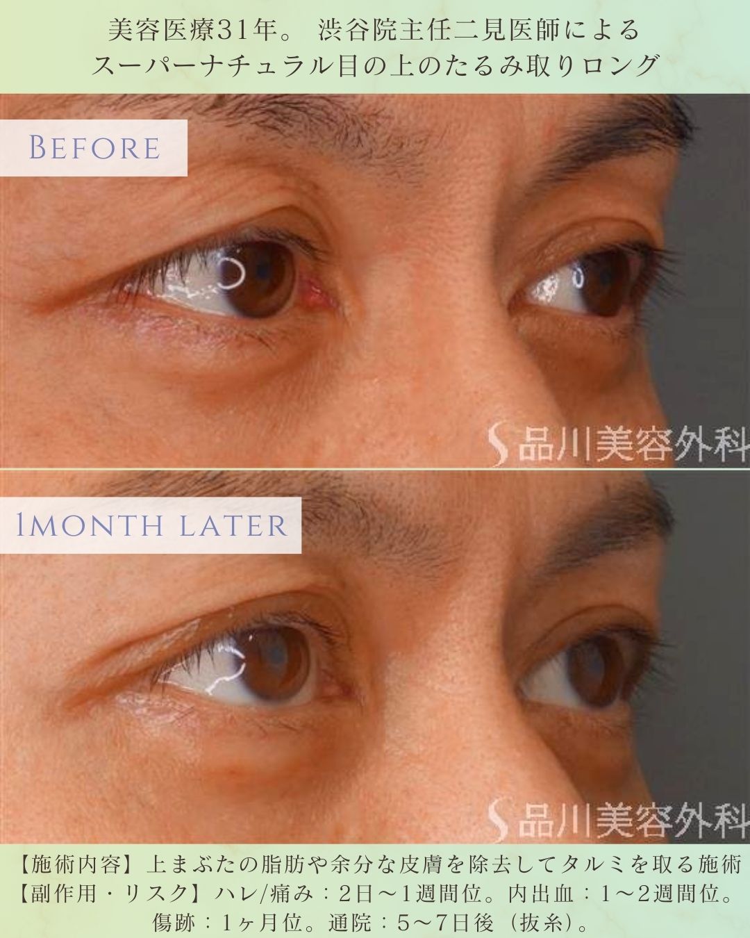 目の上のたるみ取り ビフォーアフター