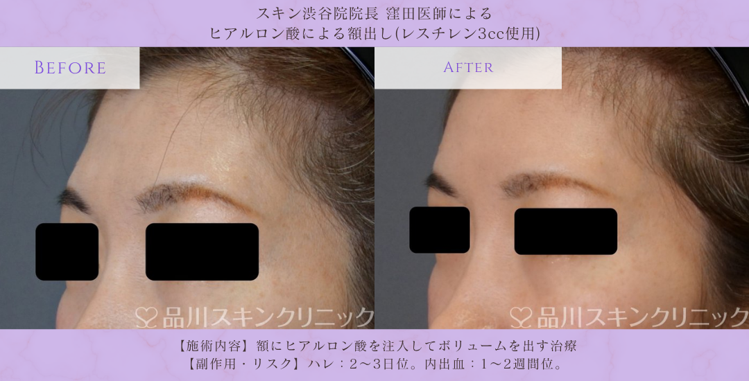 額ヒアルロン酸 注入 症例 渋谷
