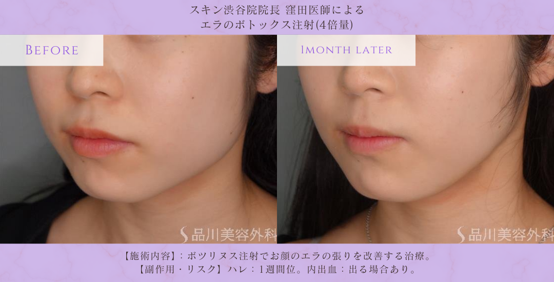 エラ張り改善 ボトックス 症例