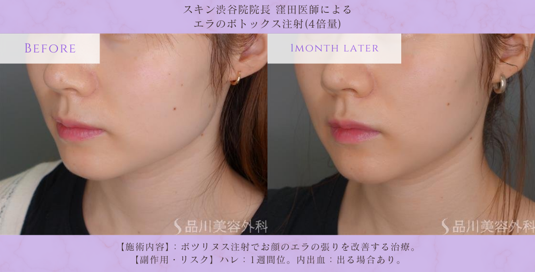 エラボトックス フェイスライン改善 症例