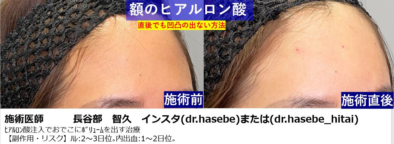 渋谷院 長谷部 智久医師によるヒアルロン酸による額出し 27 500 品川美容外科症例モニター募集 全国版