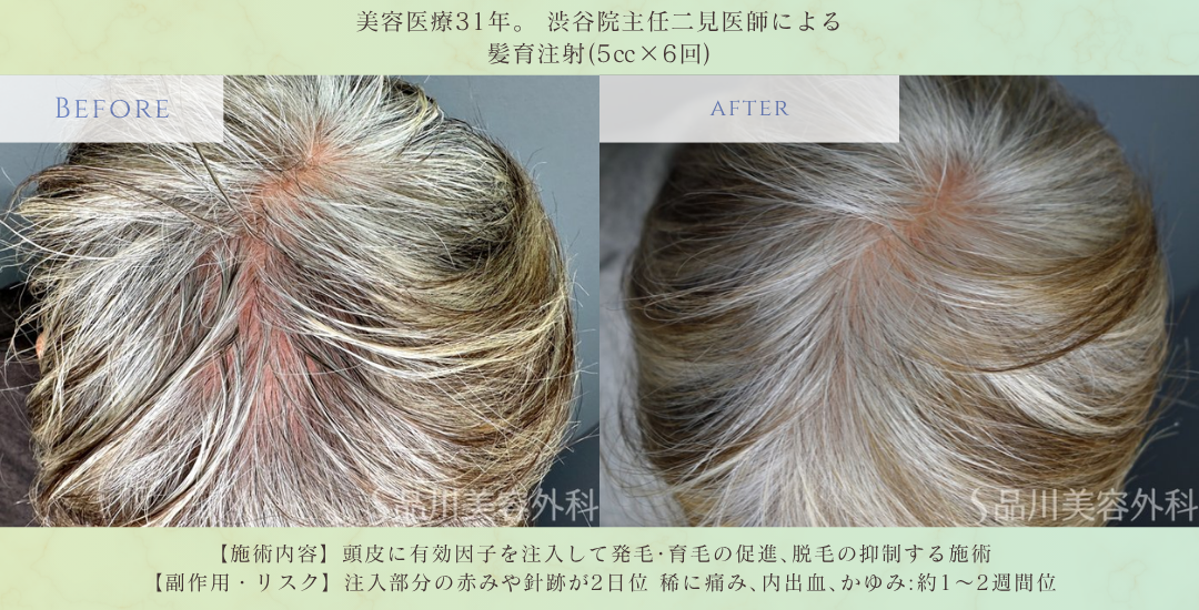 髪育注射 症例写真 術前 頭頂部薄毛