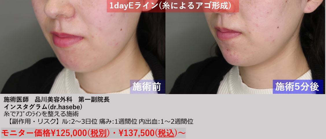 渋谷院 長谷部 智久医師による1day Eライン 137 500 品川美容外科症例モニター募集 全国版