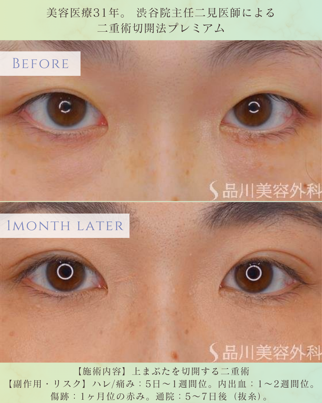 二重術切開法 症例写真 術前 一重まぶた