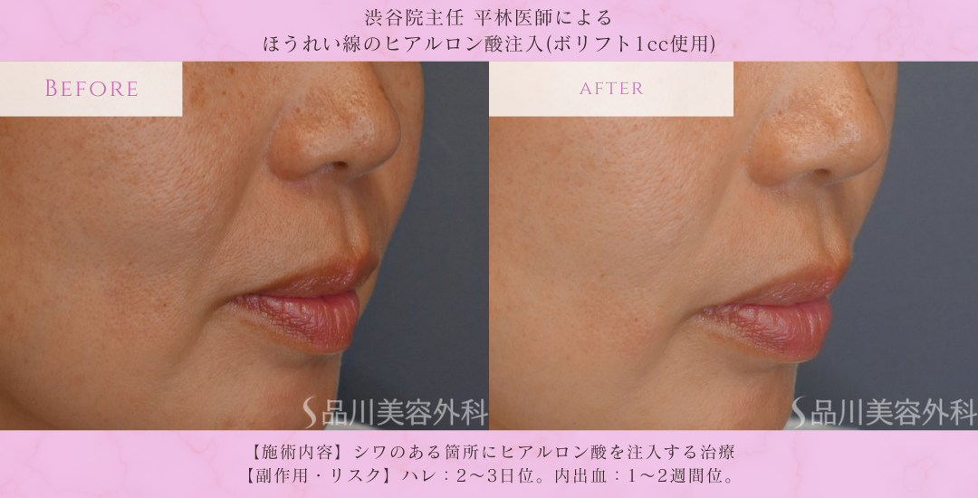 ほうれい線改善 ヒアルロン酸注入 ビフォーアフター
