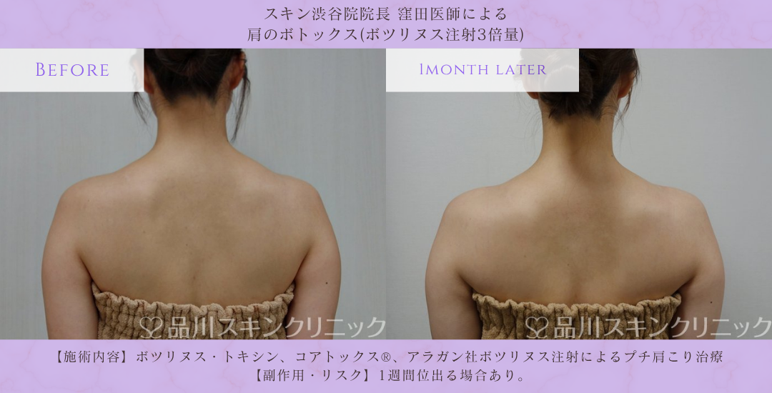 肩ボトックス 症例写真 品川スキンクリニック渋谷院