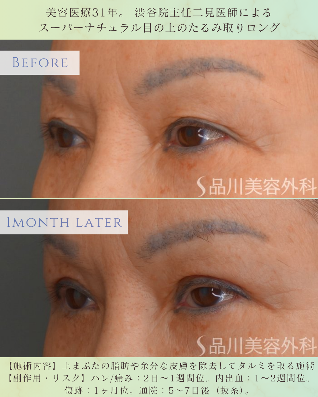 上まぶたたるみ取り 術後1ヶ月 症例