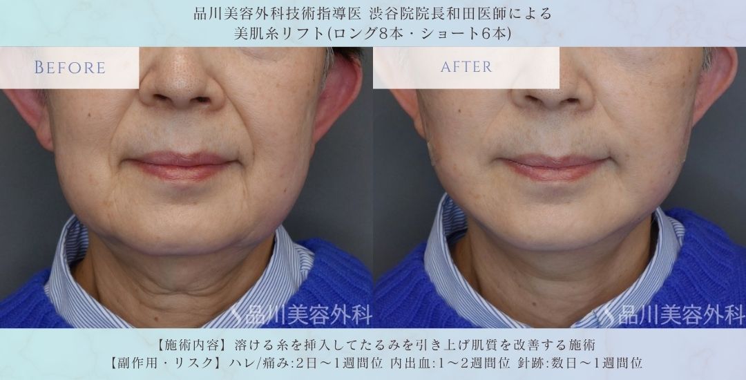自然なリフトアップ 糸リフト 症例