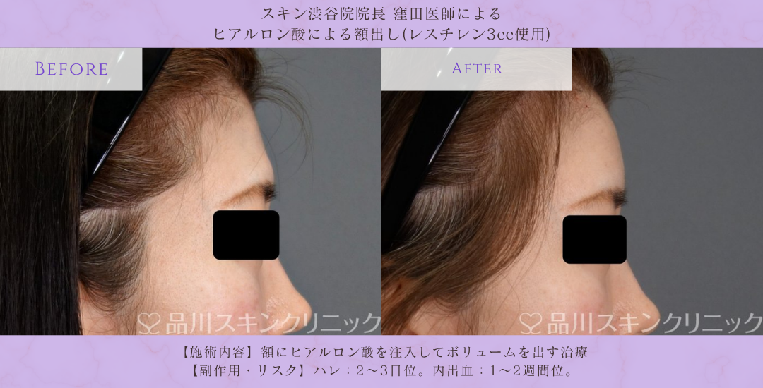額ヒアルロン酸 症例写真 品川スキンクリニック渋谷院