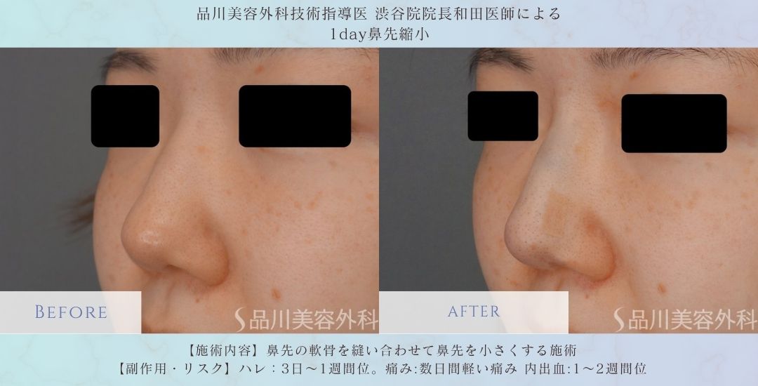 alt="1day鼻先縮小 鼻先形成 症例写真"