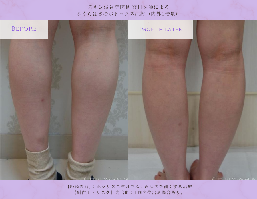 ふくらはぎボトックス 美脚治療 症例