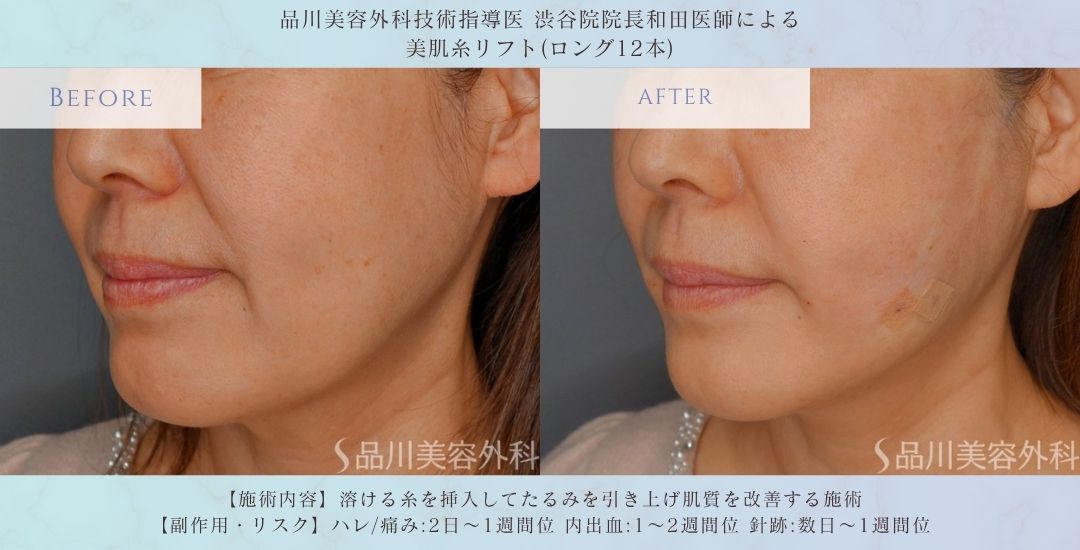 口元たるみ改善 美肌糸リフト 症例