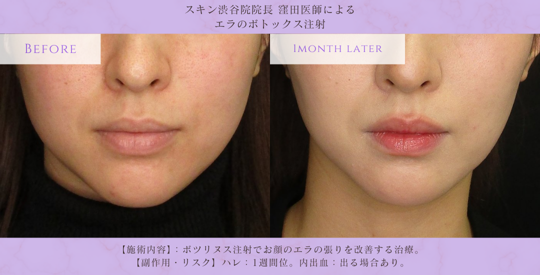 エラボトックス 小顔治療 症例 渋谷