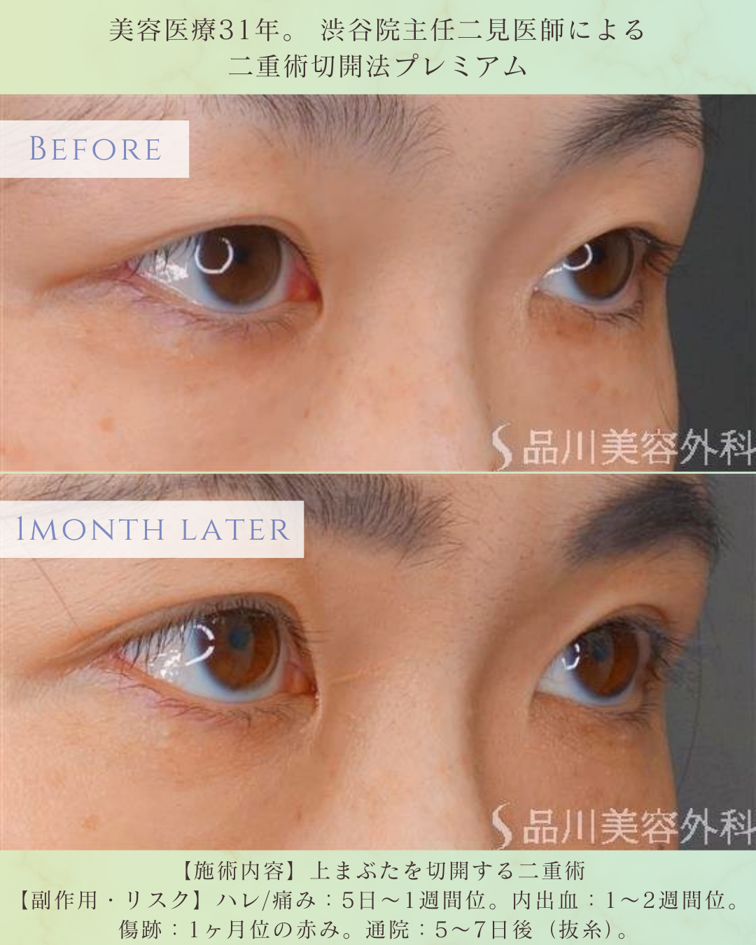 二重切開法 術後1ヶ月 症例写真