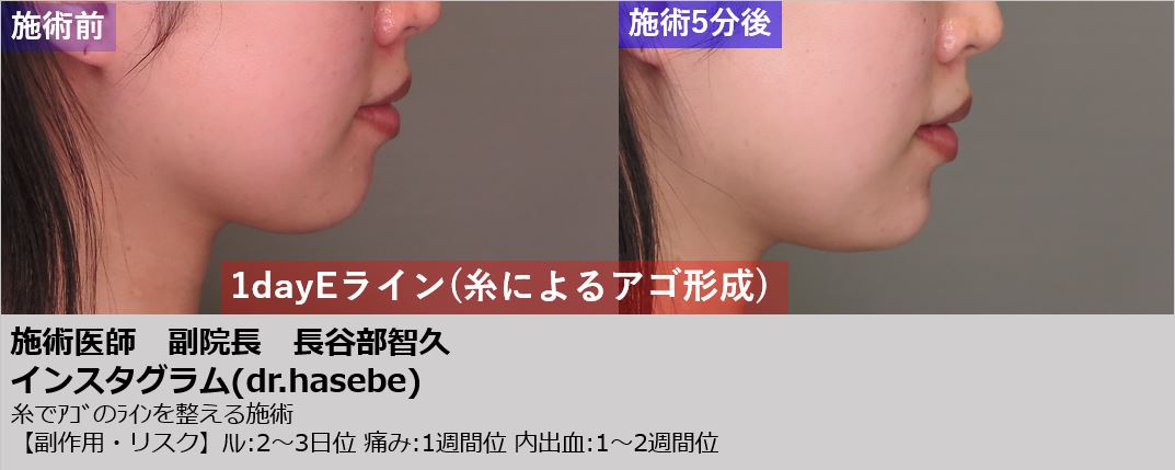 渋谷院 長谷部 智久医師による1day Eライン 137 500 品川美容外科症例モニター募集 全国版