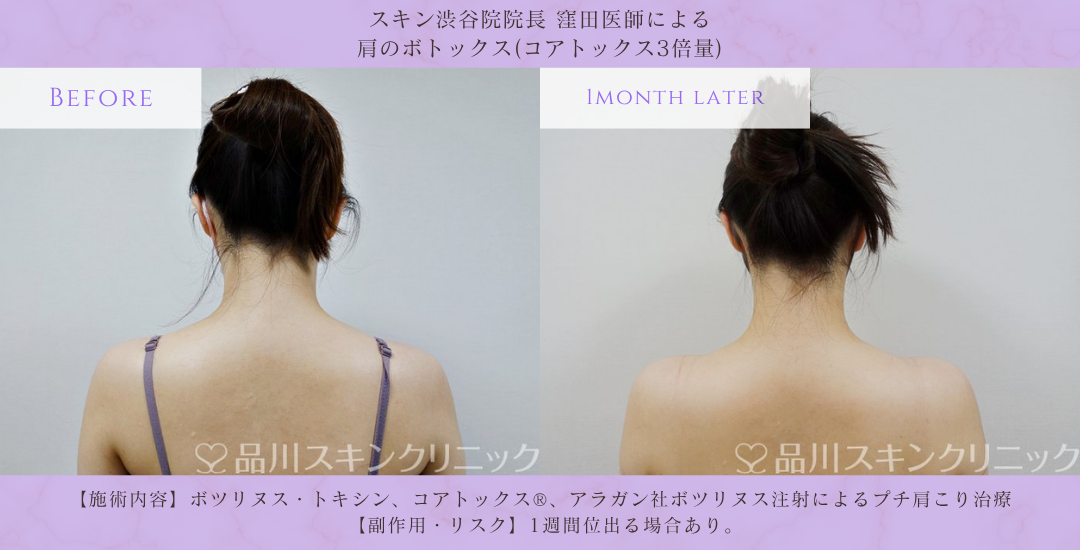 肩ボトックス 華奢見え 症例