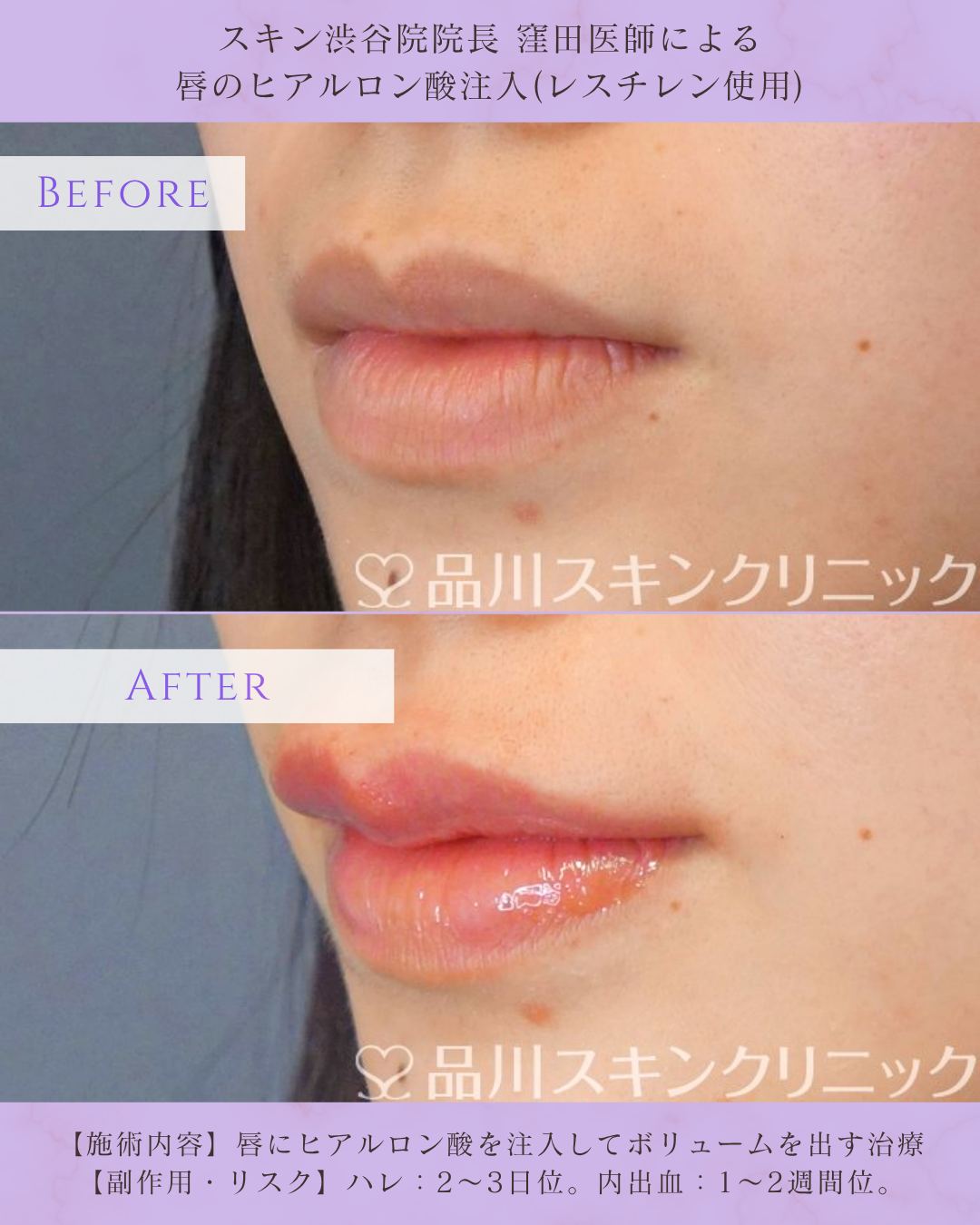 唇ヒアルロン酸 注入 症例 渋谷