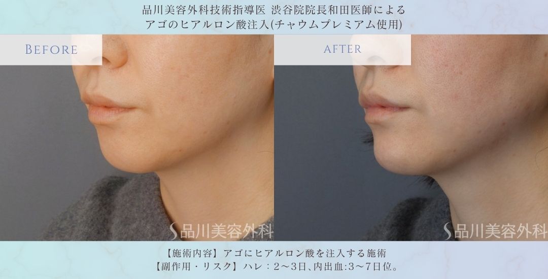 alt="アゴ形成 ヒアルロン酸 症例"