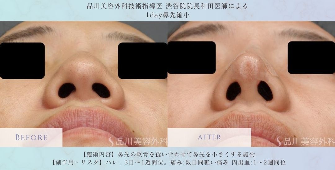 alt="鼻先形成 ビフォーアフター 症例"