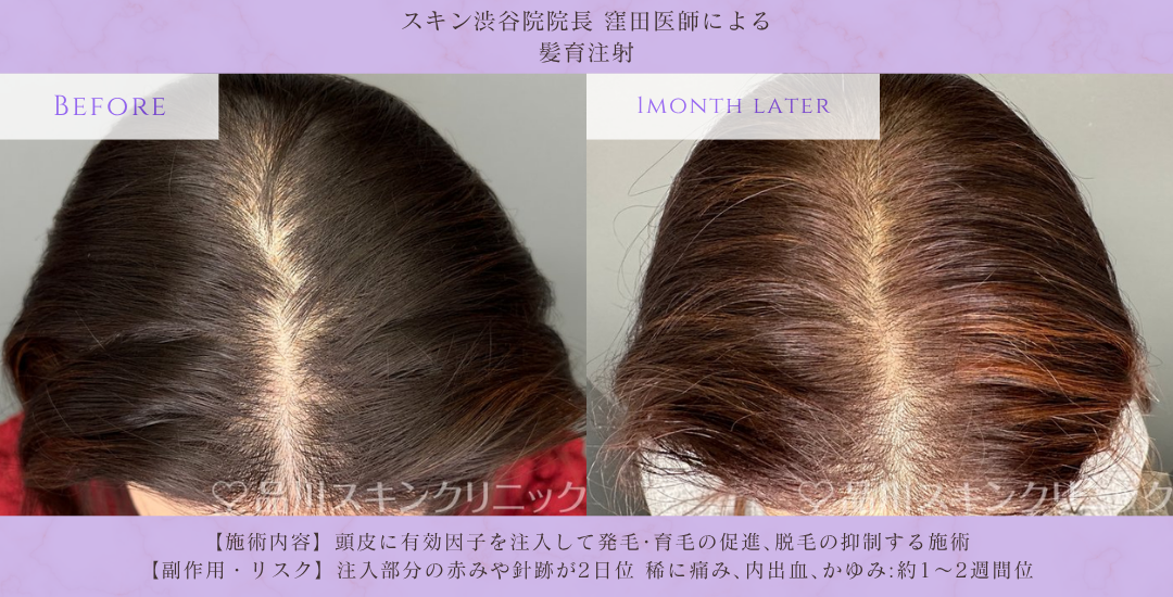 メディカル髪育注射 症例写真 品川スキンクリニック渋谷院