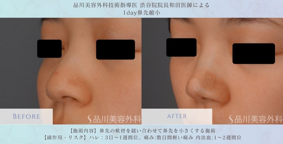 alt="鼻先縮小 団子鼻改善 症例"