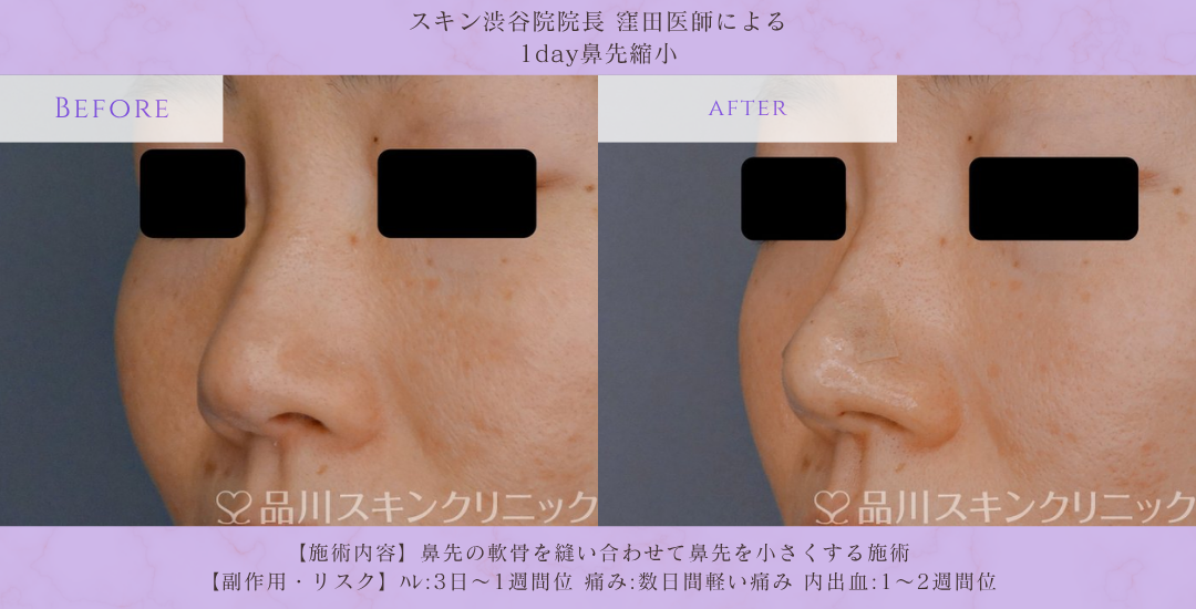鼻先縮小 モニター 症例写真