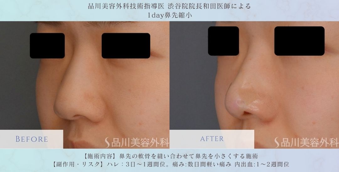 alt="鼻整形 1day鼻先縮小 症例"