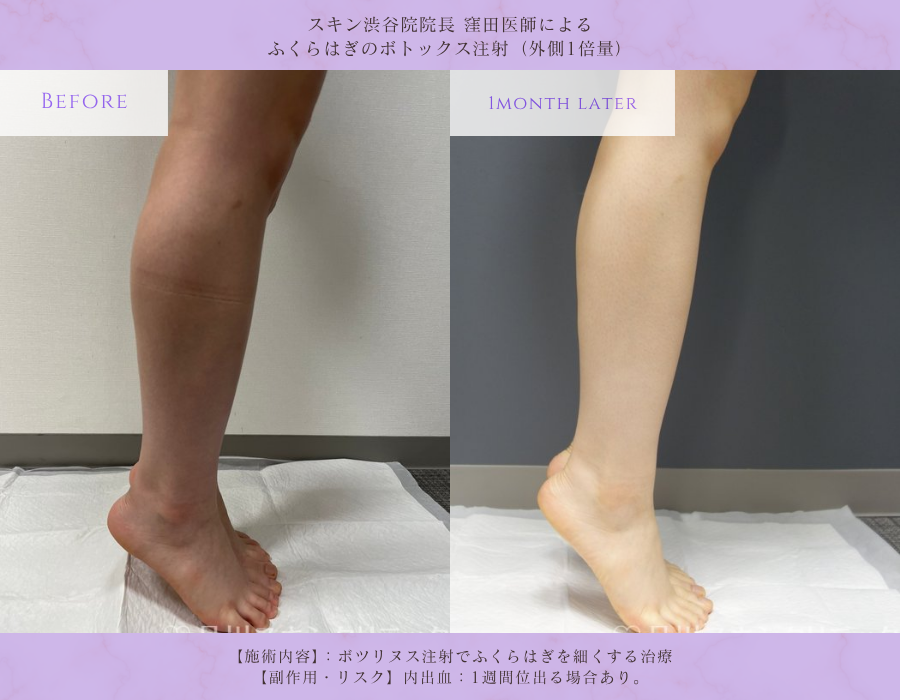 ふくらはぎボトックス 脚やせ治療 症例