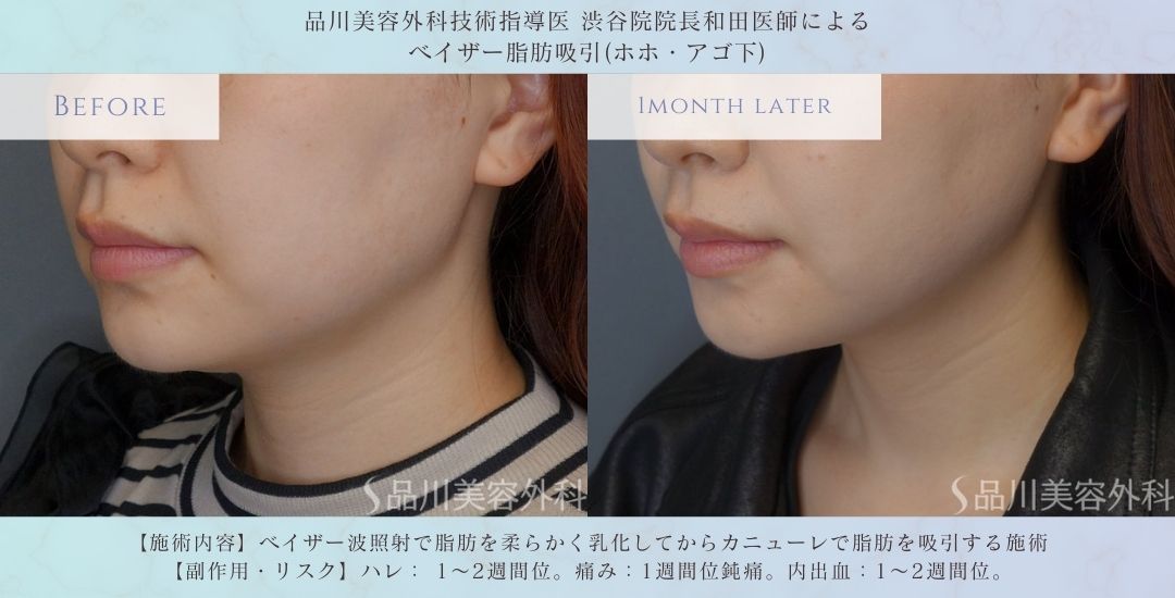 顔の脂肪吸引 症例写真 術後