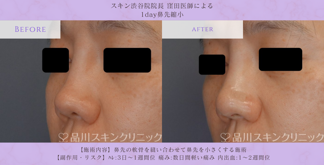 団子鼻 改善 症例