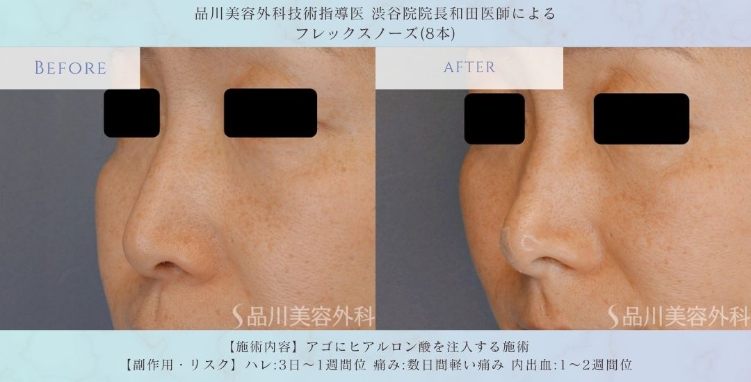 alt="鼻先形成 フレックスノーズ 症例"