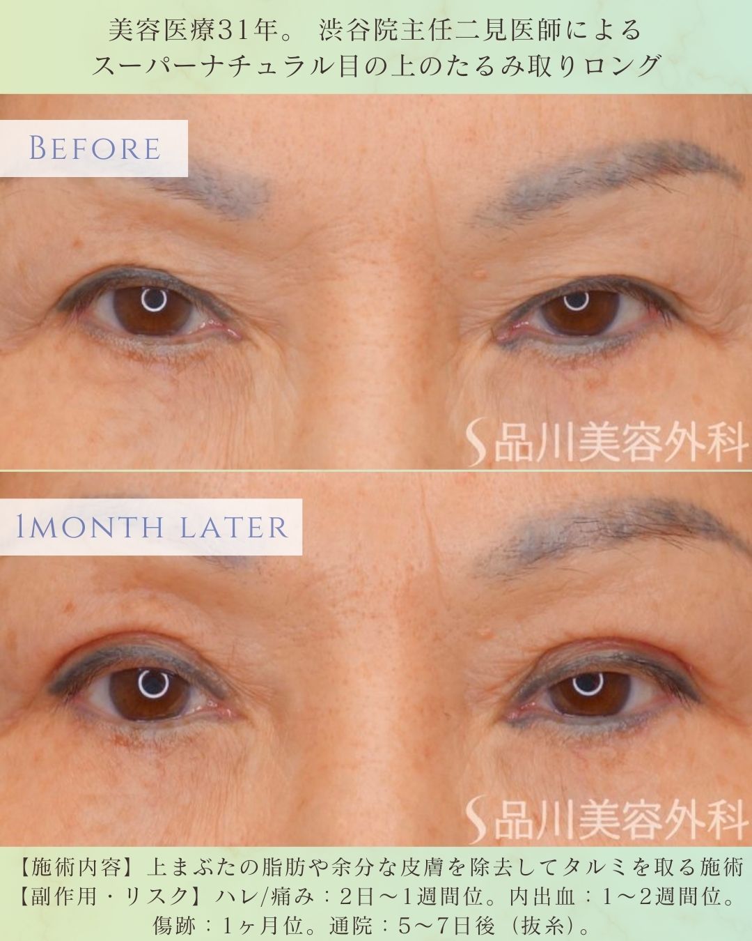 目の上のたるみ取り 症例写真 術前 上まぶたたるみ