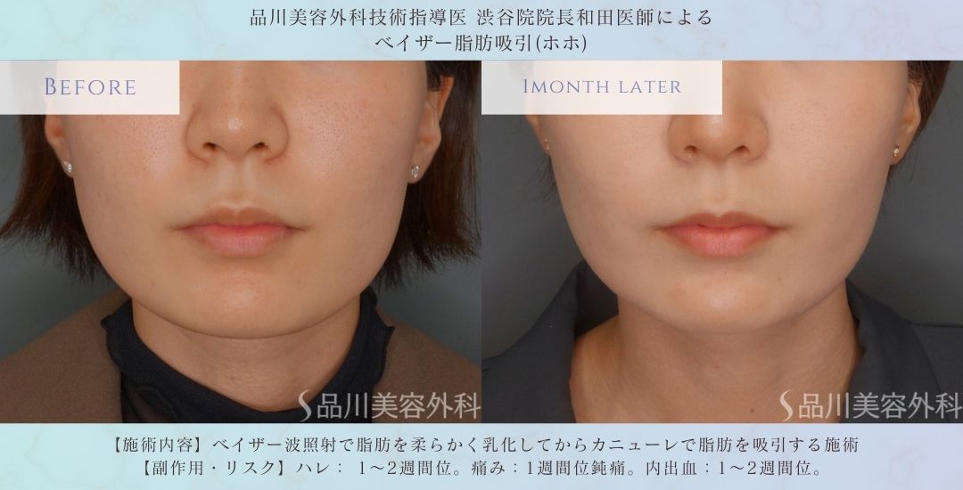 顔の脂肪吸引 渋谷 症例