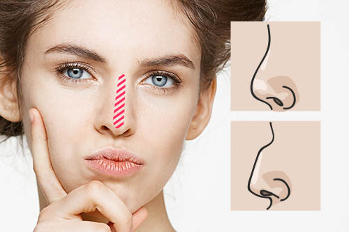 鼻の印象を左右する「鼻背（びはい）」