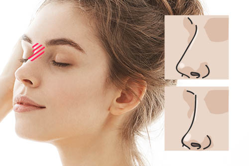 額から鼻の始まりの部分「鼻根（びこん）」